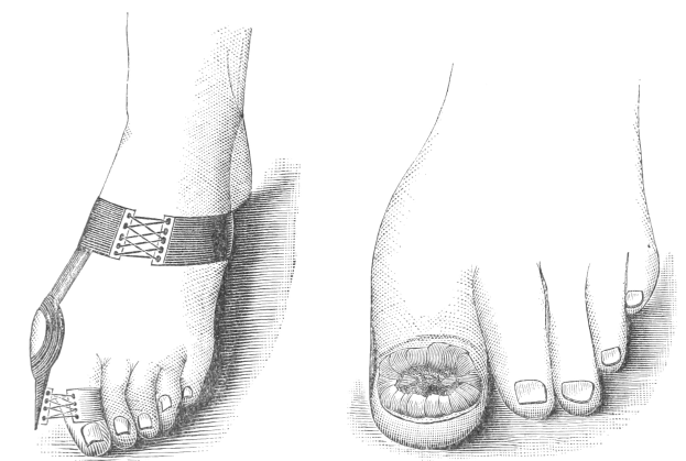 Schwarze und weiße Zeichnung von zwei Füßen, einer mit Verband und der andere mit einem Bruch, mit Textangabe zur Behandlung.
