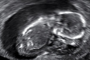 Krankenhaus Solingen: Neues Ultraschallgerät für die Kinderklinik