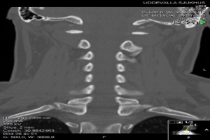 Eine MRT-Aufnahme eines Mannes am Hals mit einer sichtbaren Fraktur, die auf einem Computerbildschirm angezeigt wird.