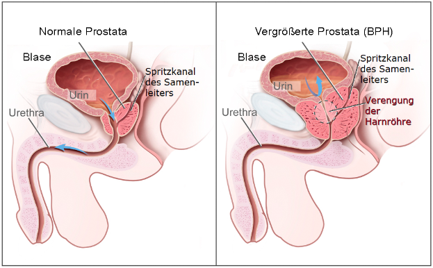 Eine Abbildung der männlichen Geschlechtsorgane mit "Prostata" und "BPH" beschriftet, die verschiedene Stadien von Prostatakrebs in unterschiedlichen Blautönen zeigt.